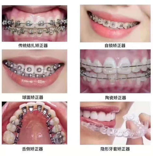 關(guān)于成人牙齒正畸價(jià)格的深度探討與解析