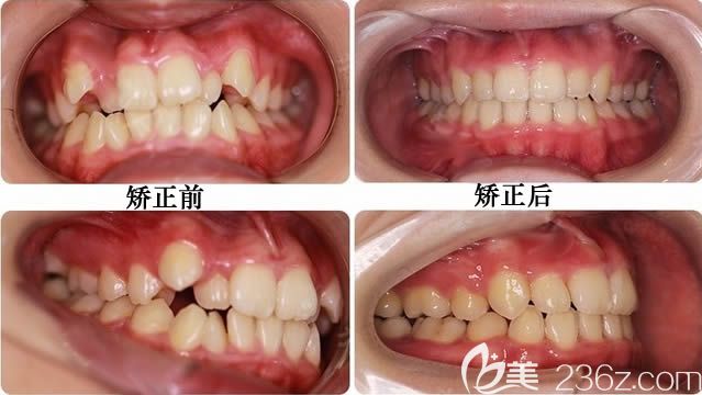 關(guān)于成人牙齒正畸價(jià)格的深度探討與解析
